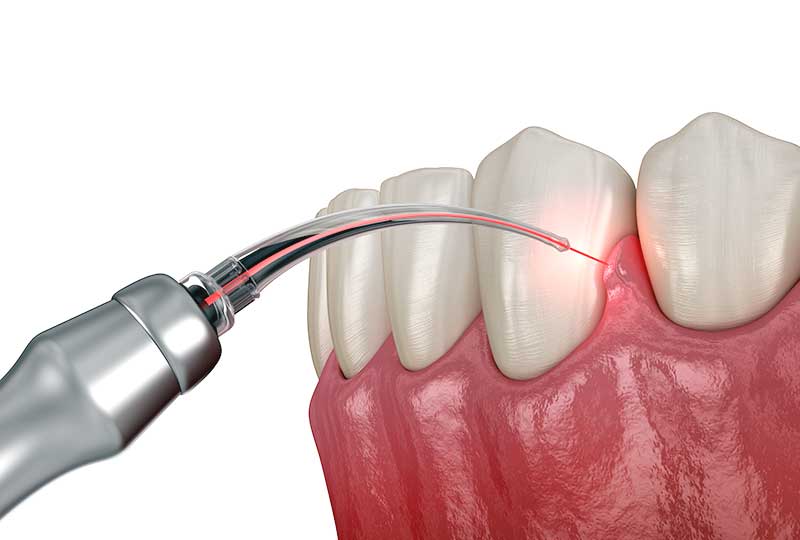 laser-surgery-graphic