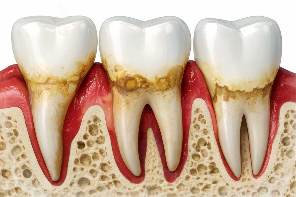Cross-section illustration of teeth with decay, gum recession, and bone loss.